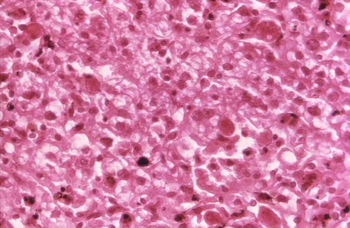 Transmission electron micrograph (TEM) reveals the presence of numerous St. Louis encephalitis virions that were contained within a central nervous system tissue sample. From Public Health Image Library (PHIL). [4]