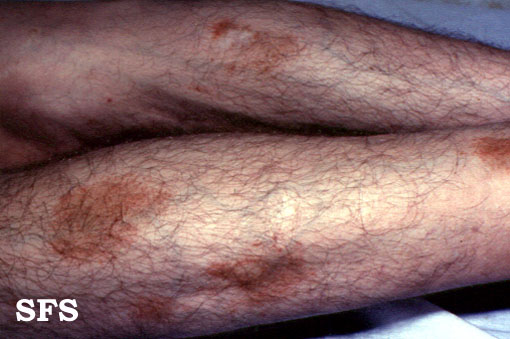 Majocchi’s disease. With permission of Dermatology Atlas<ref name="www.atlasdermatologico.com.br">"Dermatology Atlas".