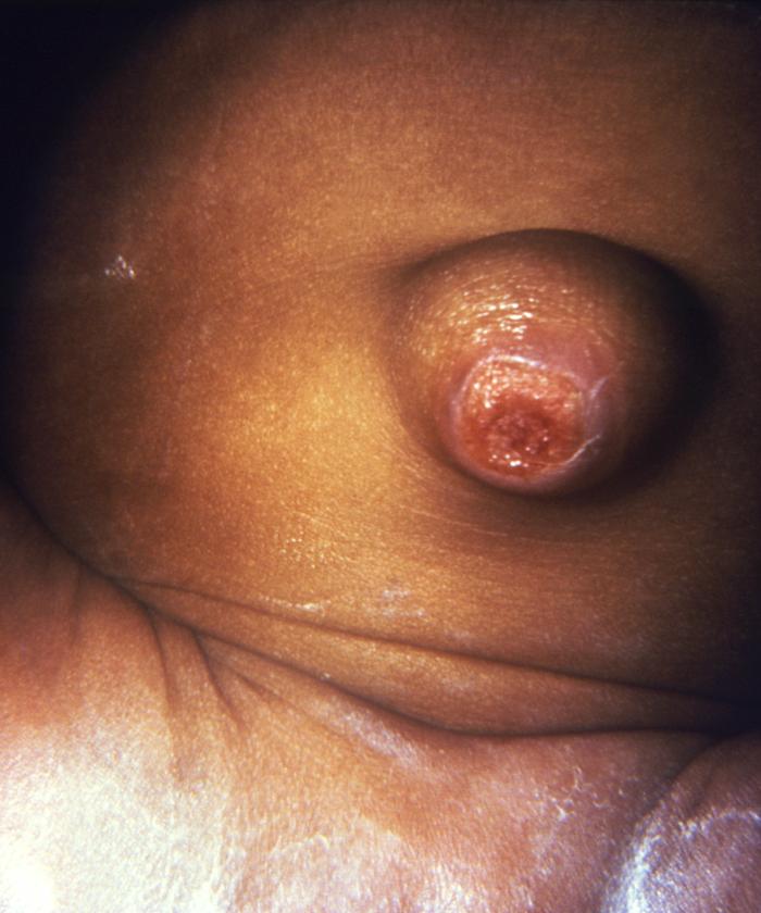 This image depicted the umbilicus of an infant, which displayed an inflamed lesion that under a darkfield examination revealed the presence of Treponema pallidum spirochetes, and hence, a diagnosis of congenital syphilis. Syphilis is a sexually transmitted disease (STD) caused by the bacterium Treponema pallidum. It has often been called "the great imitator" because so many of the signs and symptoms are indistinguishable from those of other diseases. It is passed from person to person through direct contact with a syphilis sore. Sores occur mainly on the external genitals, vagina, anus, or in the rectum. Sores also can occur on the lips and in the mouth. Transmission of the organism occurs during vaginal, anal, or oral sex. Pregnant women with the disease can pass it to the babies they are carrying. Syphilis cannot be spread through contact with toilet seats, doorknobs, swimming pools, hot tubs, bathtubs, shared clothing, or eating utensils. Adapted from CDC