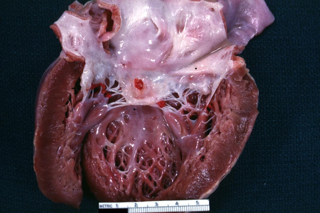 Bacterial Endocarditis: (Gross) An excellent image of vegetations on mitral valve evidence of rheumatic scarring