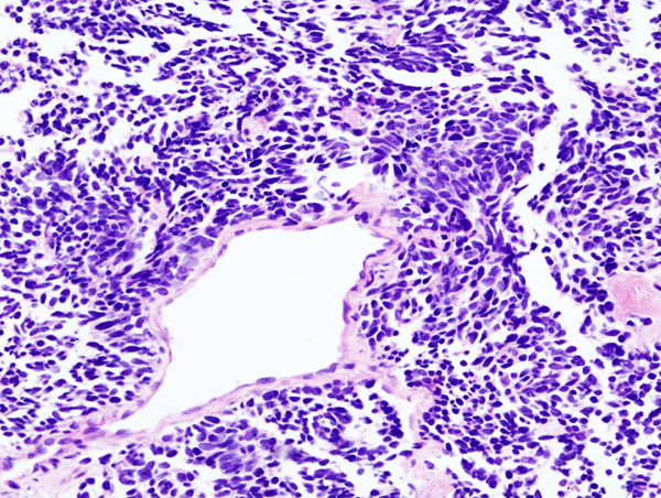 Small cell carcinoma of the lung pathophysiology wikidoc