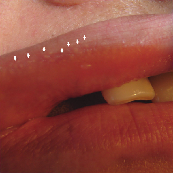 Extraoral photograph image showing Fordyce granules in the upper lip (arrows) of individual III:5 with hereditary nonpolyposis colorectal cancer and colorectal cancer.Creative Commons BY-SA-NC[1]