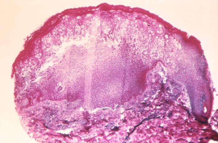 hematoxylin and eosin (H&E)-stained tissue sample, reveals some of the histopathologic changes found in a human skin tissue sample from the site of a smallpox lesion. Adapted from Public Health Image Library (PHIL), Centers for Disease Control and Prevention.[14]