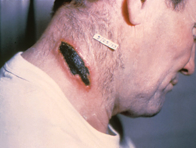 "Anthrax lesion on the neck”Adapted from Public Health Image Library (PHIL), Centers for Disease Control and Prevention.[20]