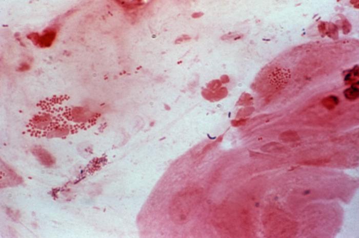 Neisseria gonorrhoeae in cervical smear using the Gram-stain[6]