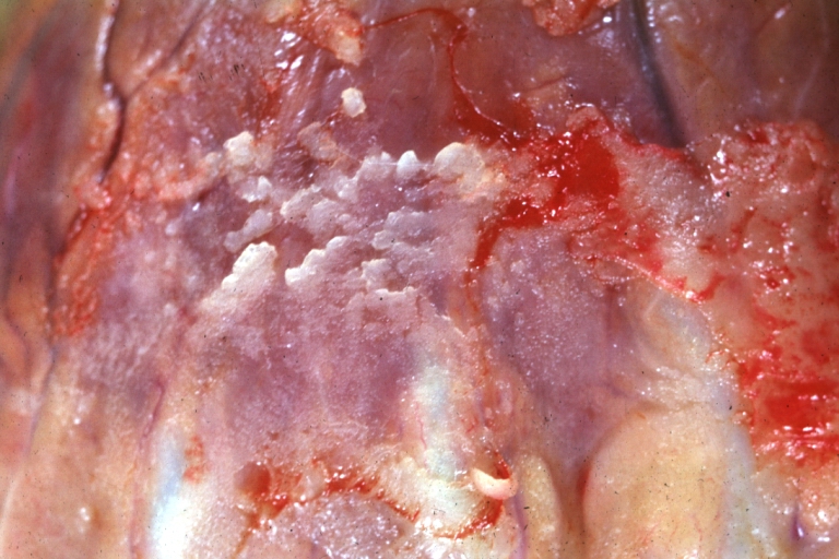 Fibrinous pericarditis: Gross, natural color, very close-up photo showing fibrinous exudate simulating frost (an excellent example).
