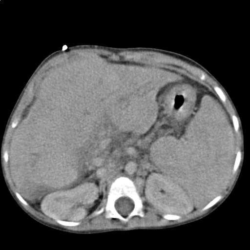 Liver cirrhosis as seen on an axial CT of the abdomen.