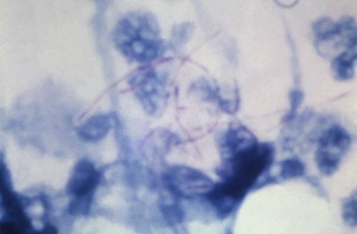 Acid-fast stained photomicrograph depicts Gram-positive aerobic Nocardia asteroides bacteria, present in a patient’s sputum sample. From Public Health Image Library (PHIL). [1]