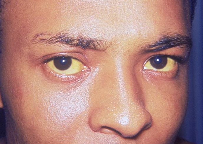 The viral disease Hepatitis A is manifested here as icterus, or jaundice of the conjunctivae and facial skin. Adapted from Public Health Image Library (PHIL), Centers for Disease Control and Prevention.[1]