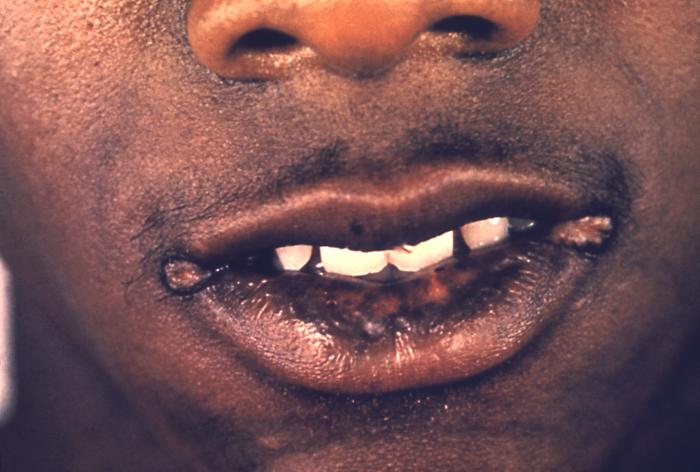 This patient presented with secondary syphilitic lesions of the lips. Note the split papules at the angles of the mouth. Second-stage symptoms can include fever, swollen lymph glands, sore throat, patchy hair loss, headaches, weight loss, muscle aches, and tiredness. A person can easily pass the disease to sex partners during the primary or secondary stage of the disease. Adapted from CDC