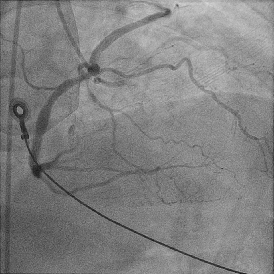 Figure 6. Right anterior oblique cineangiography of the right coronary artery (RCA) following coronary stenting. LCx (left circumflex coronary artery); LAD (left anterior descending coronary artery)
