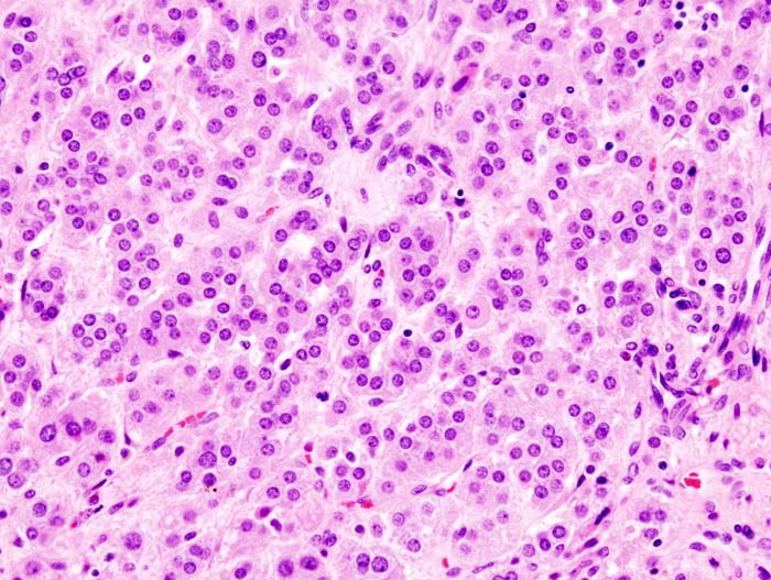 Adrenal adenoma microscopic picture, source: By Michael Feldman, MD, PhDUniversity of Pennsylvania School of Medicine - CC BY-SA 3.0, https://commons.wikimedia.org/w/index.php?curid=535950