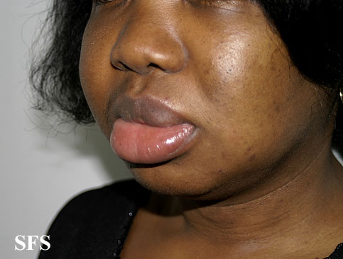 Angioedema. Adapted from Dermatology Atlas.[1]