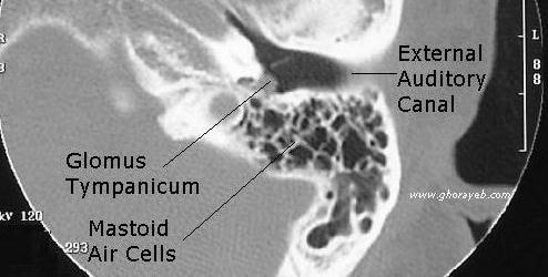 Axial CT scan showing the glomus tumor growing from the medial wall of the middle ear[5].