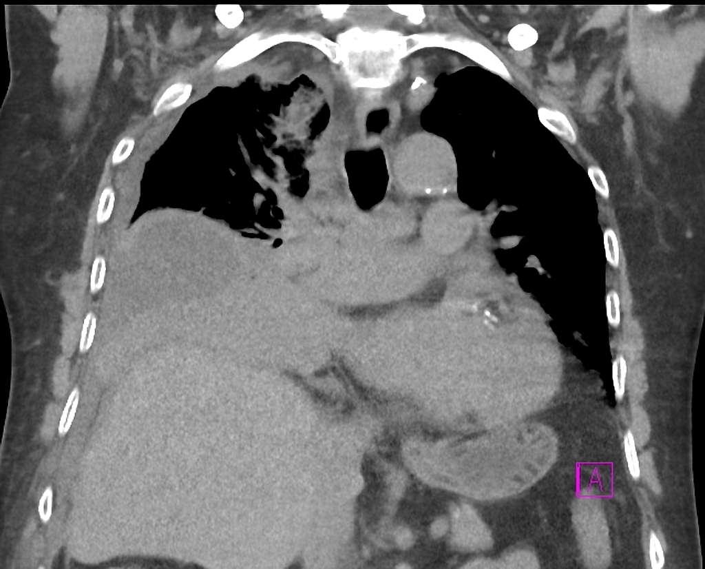 Large cell neuroendocrine carcinoma of the lung: lower lobe collapse