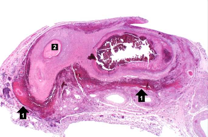 File:Polyarteritis nodosa. a case example 6.jpg