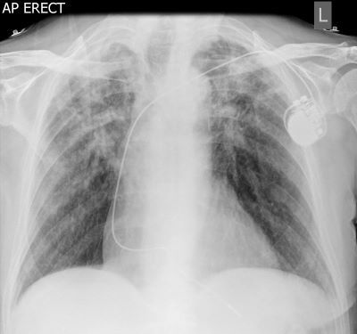 Pneumoconiosis with massive pulmonary fibrosis - Case courtesy of Dr Ian Bickle, <a href="https://radiopaedia.org/">Radiopaedia.org</a>. From the case <a href="https://radiopaedia.org/cases/50303">rID: 50303</a>