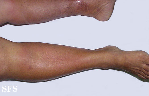 Weber christian disease. Adapted from Dermatology Atlas.[4]
