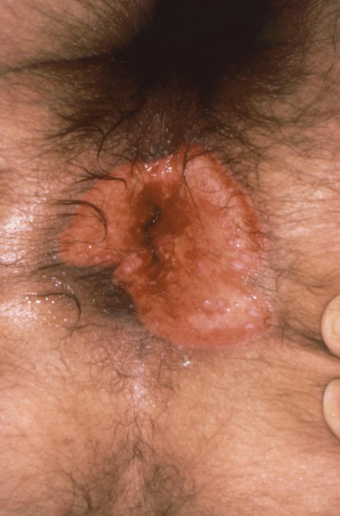 This image depicts the perineal region of a male patient which displayed a perianal mucocutaneous lesion caused by a herpes simplex infection. Genital herpes is a sexually transmitted disease (STD) caused by the herpes simplex viruses type 1 (HSV-1) or type 2 (HSV-2). Most genital herpes is caused by HSV-2. Most individuals have no or only minimal signs or symptoms from HSV-1 or HSV-2 infection. When signs do occur, they typically appear as one or more blisters on or around the genitals or rectum. The blisters break, leaving tender ulcers (sores) that may take two to four weeks to heal the first time they occur. Typically, another outbreak can appear weeks or months after the first, but it almost always is less severe and shorter than the first outbreak. Although the infection can stay in the body indefinitely, the number of outbreaks tends to decrease over a period of years. Adapted from CDC