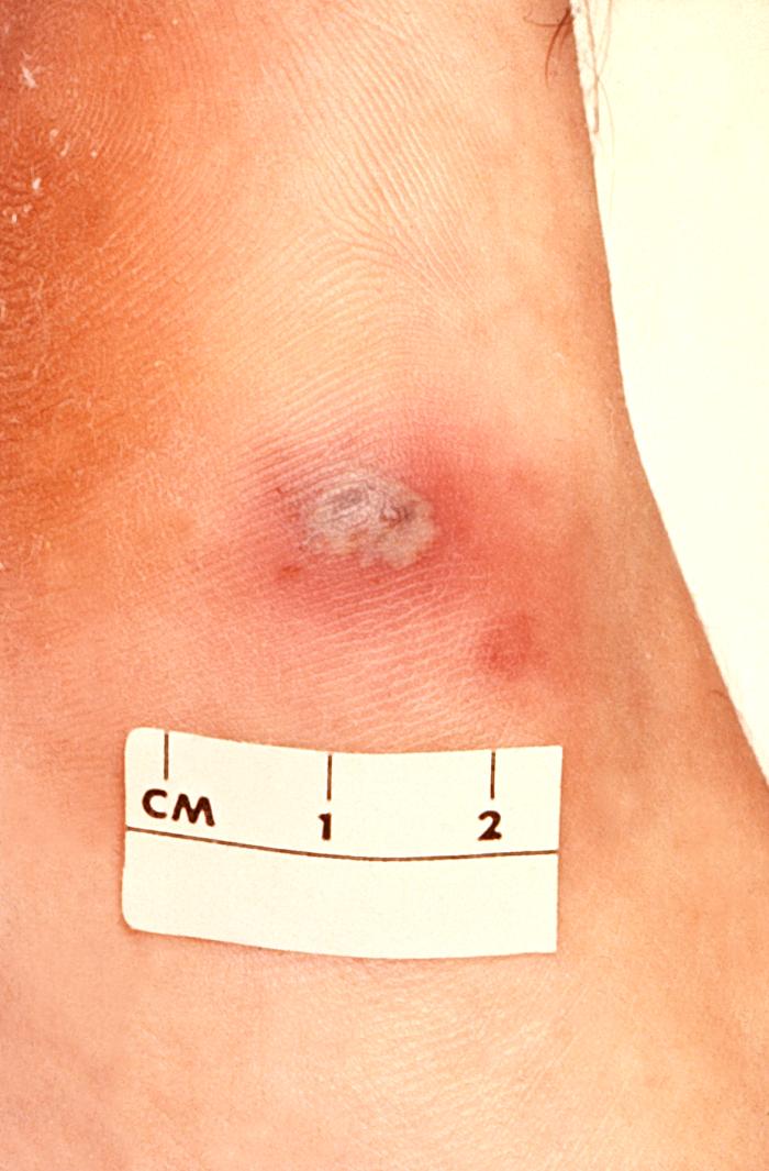 This patient presented with a cutaneous gonococcal lesion due to a disseminated Neisseria gonorrhea bacterial infection. Though a sexually transmitted disease, if a Gonorrhea infection is allowed to go untreated, the Neisseria gonorrhea bacteria responsible for the infection can become disseminated throughout the body, forming lesions in extra-genital locations. Adapted from CDC