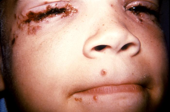 This 7 year old child with history of recurrent herpes labialis presented with a periocular herpes simplex vesicular outbreak. Herpes simplex virus, otherwise known as Herpesvirus hominis is a member of a group of viruses including those which cause oral herpes (herpes labialis), i.e., usually HSV-1, and genital herpes, i.e., usually HSV-2. Adapted from CDC