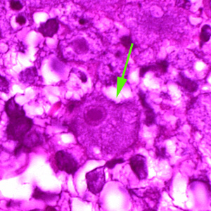 A single trophozoite (green arrow) of B. mandrillaris in brain tissue, stained with H&E. Adapted from CDC