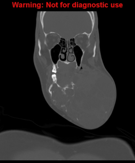 Coronal bone window ameloblastoma