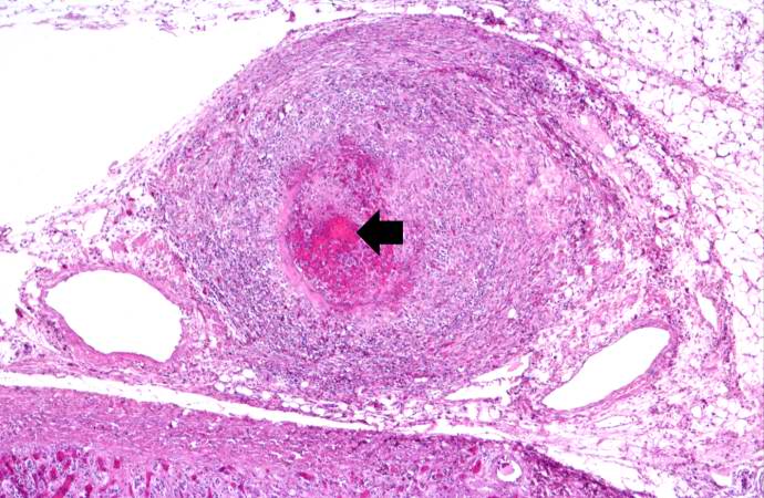 File:Polyarteritis nodosa. a case example 10.jpg