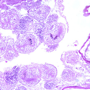 Echinococcus multilocularis in tissue, stained with H&E. Magnification at 200x. Adapted from CDC