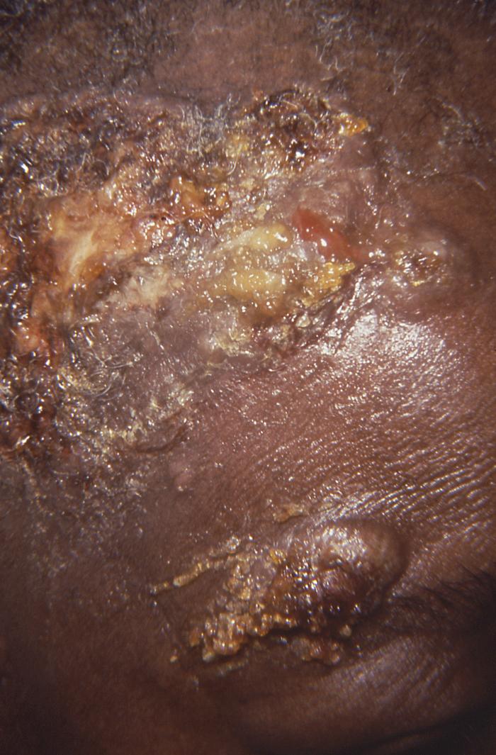 Lesions of patient’s forehead proved to be impetigo, usually caused by Staphylococcus aureus bacteria. Adapted from Dermatology Atlas.[4]