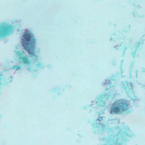 Trophozoites of P. hominis in a stool specimen, stained with trichrome. Adapted from CDC