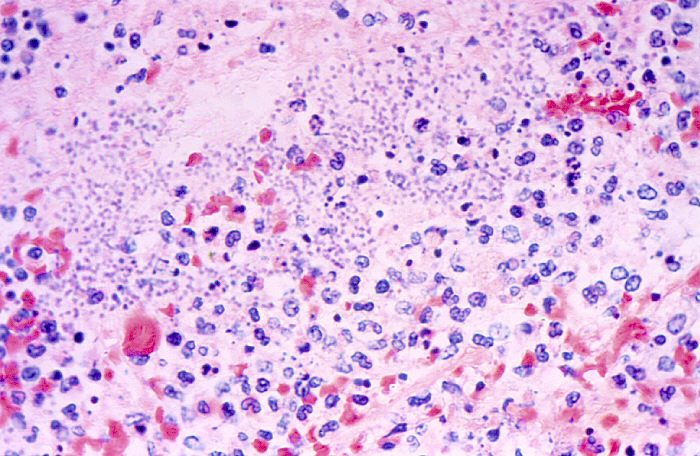 Photomicrograph of lung tissue revealing Yersinia pestis organisms Adapted from Public Health Image Library (PHIL), Centers for Disease Control and Prevention.[15]