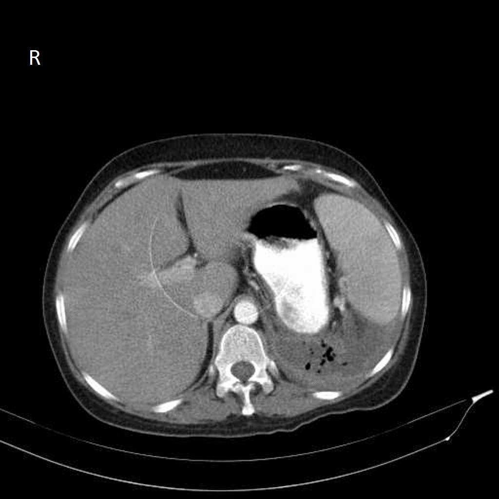 Case courtesy of Dr MohammadTaghi Niknejad, <a href="https://radiopaedia.org/">Radiopaedia.org</a>. From the case <a href="https://radiopaedia.org/cases/20859">rID: 20859</a>