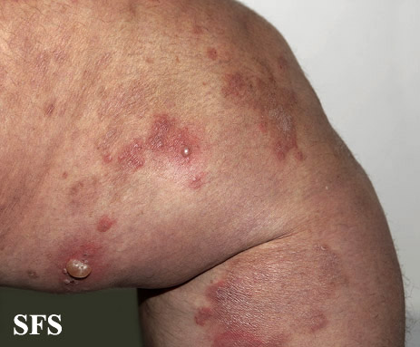 File:Dermatitis herpetiformis39.jpg