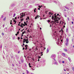 File:Pneumocystis HB1.jpg