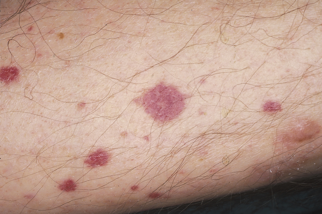 Vasculitis: In this instance, the vasculitic skin lesions were secondary to Haemophilus endocarditis.