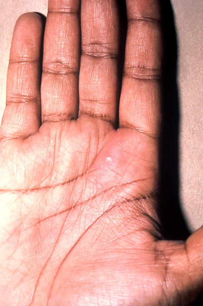 This patient presented with a cutaneous lesion on the palm of his right hand due to a N. gonorrhoeae infection. Though sexually transmitted, and involving the urogenital tract initially, a Neisseria gonorrhoeae bacterial infection can become disseminated systemically, manifesting itself as a cutaneous erythematous lesion anywhere on the body. Adapted from CDC