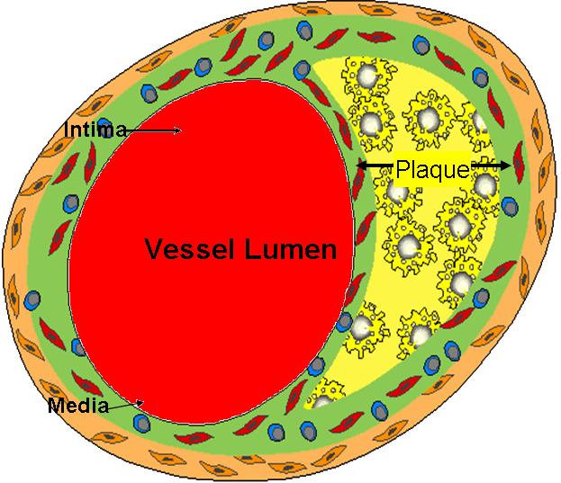 Diagram of arterial lumen (Image courtesy of Amjad Almahameed)