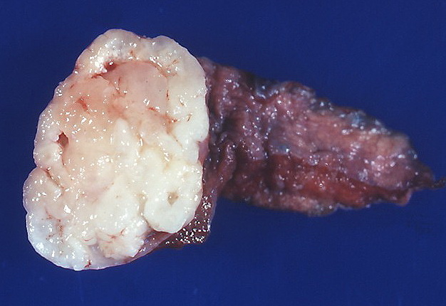 Gross pathology of pulmonary hamartoma.[7]