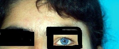 Oculocutaneous albinism. With permission from Dermatology Atlas.[1]