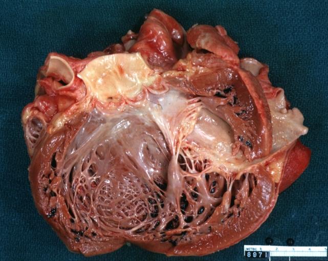 Dilated Cardiomyopathy: Gross good example huge dilated left ventricle