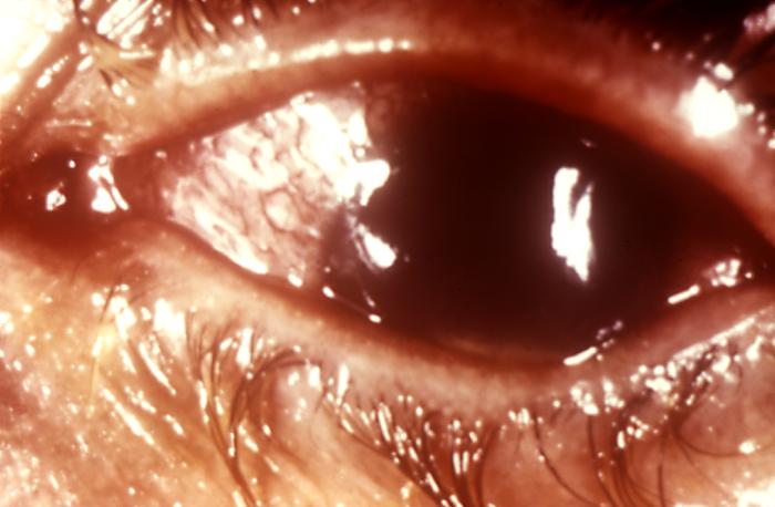 This patient presented with ophthalmic inflammation that was diagnosed as gonococcal conjunctivitis. Though sexually transmitted, and involving the urogenital tract initially, a Neisseria gonorrhoeae bacterial infection can become disseminated systemically, manifesting itself as cutaneous ulcerations or conjunctival inflammation. Adapted from CDC