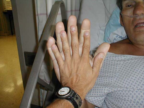 Markedly enlarged hand resulting from excess growth hormone. For reference purposes, the comparison hand is size 6 1/2.