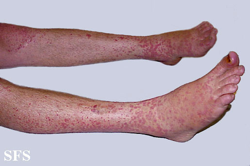 File:Allergic vasculitis 01.jpeg