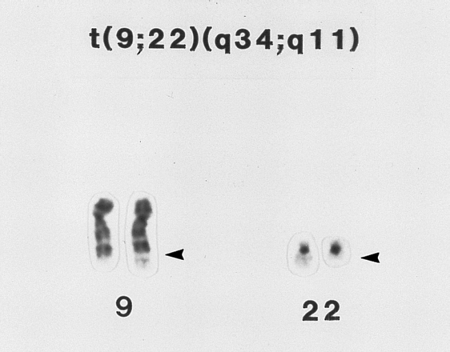 Chronic Myeloid Leukemia: Philadelphia Chromosome. Partial karyotype of a myeloid cell from the bone marrow of a patient with CML showing the typical t(9;22) translocation. (G-banded, Wright-Giemsa stained)