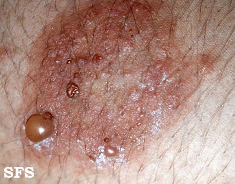 File:Dermatitis herpetiformis06.jpg
