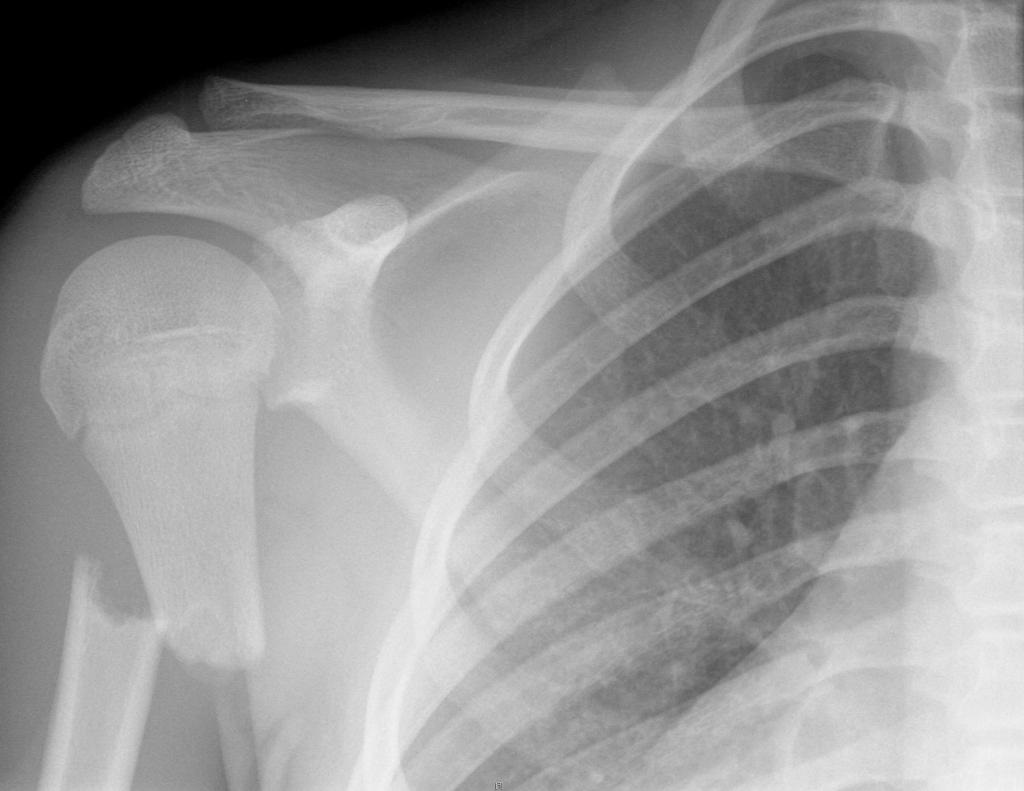 Transverse fracture through the proximal diaphysis of the left humerus, with complete displacement and slight overlap. Open growth plate noted.