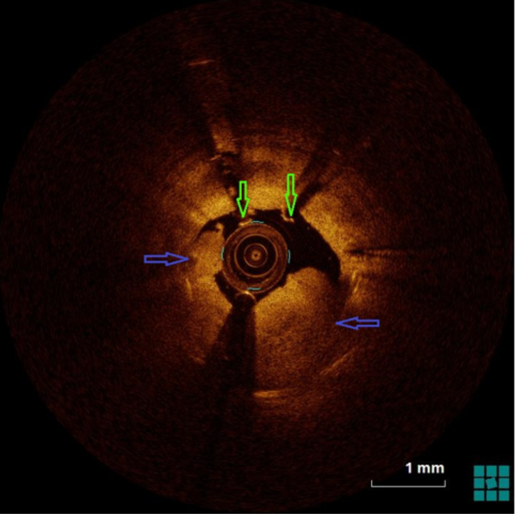Figure 2. OCT demonstrating large white thrombus (blue arrows) and focal areas of stent malposition (green arrows)