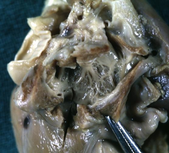 Cor Triatriatum: Gross fixed tissue opened superior atrial chamber
