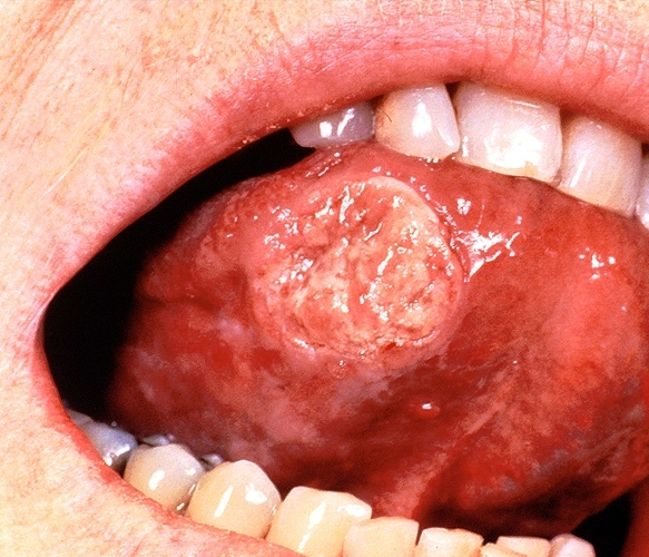 File:Squamous cell carcinoma oral 001.jpg